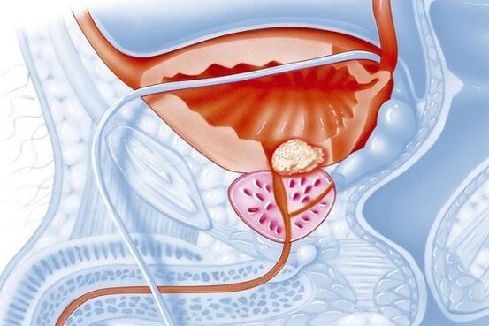 Processus inflammatoire de la prostate